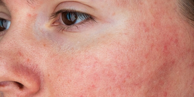 Rosacea-Triggers-1-uai-1200x800
